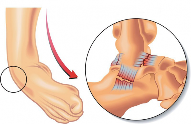 Bong gân là tình trạng phổ biến gây đau khớp cổ chân