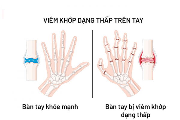 Viêm khớp dạng thấp là một loại viêm khớp phổ biến