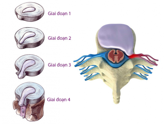 Các giai đoạn của bệnh thoát vị đĩa đệm