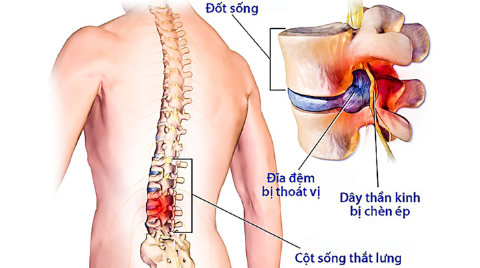 Nhân nhầy của đĩa đệm cột sống chệch ra khỏi vị trí bình thường