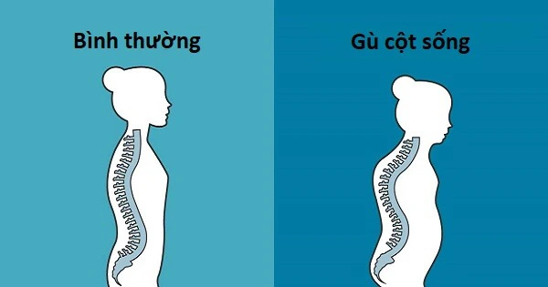 Gù cột sống