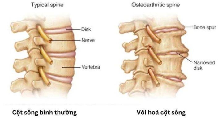 Thoái hóa đốt sống