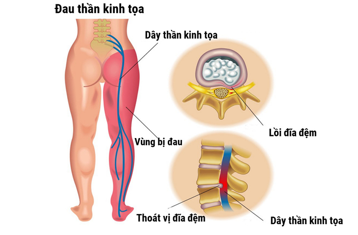 Đau thần kinh tọa thường gặp ở người từ 30 - 50 tuổi