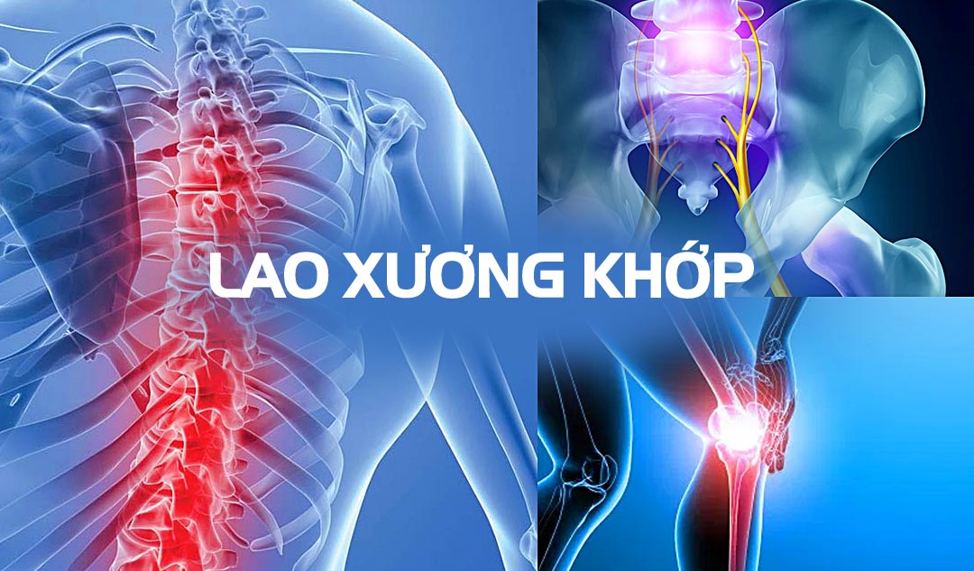 Lao xương khớp