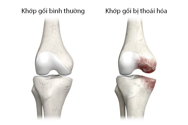 Thoái hóa khớp gối